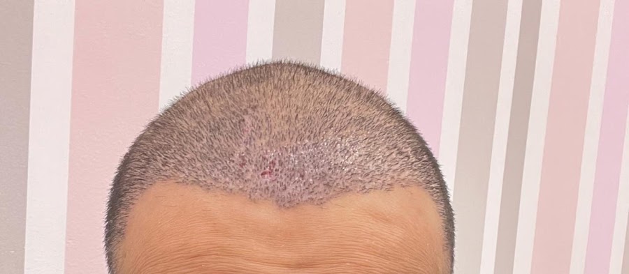 Dr Rabindra Yadav Best Hair Transplant Clinic in Abu Dhabi, Dubai, UAE at Reem I — photo 2