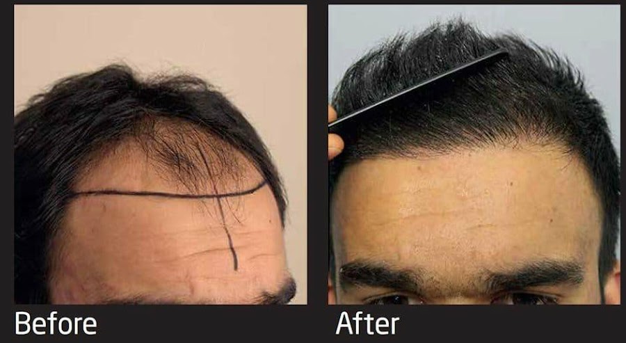 Dr Rabindra Yadav Best Hair Transplant Clinic in Abu Dhabi, Dubai, UAE at Reem I — photo 4