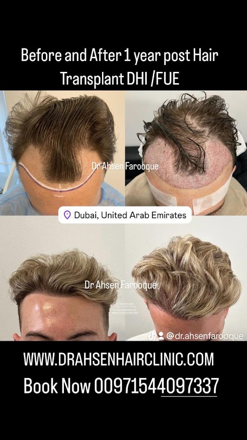 Dr Ahsen Farooque MD ABHRS USA Dhi Fue Fut Hair Transplant Surgeon Dubai — photo 4