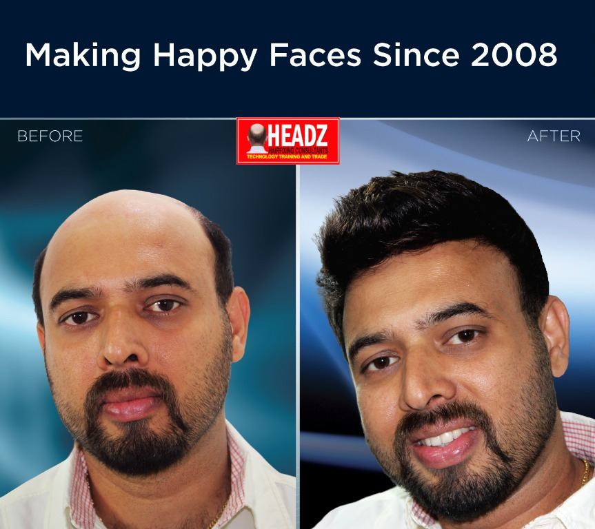 Headz Hair Fixing Centre | Hair Replacement — photo 2