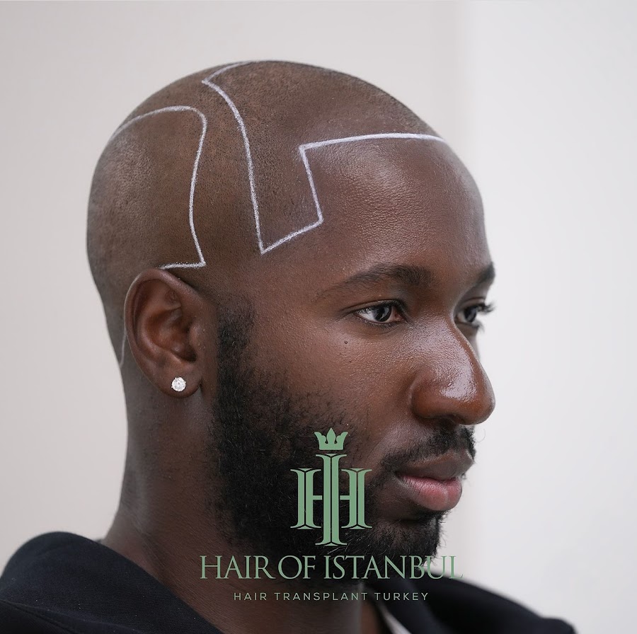 Hair of Istanbul Dubai - Hair Transplant Clinic — photo 3