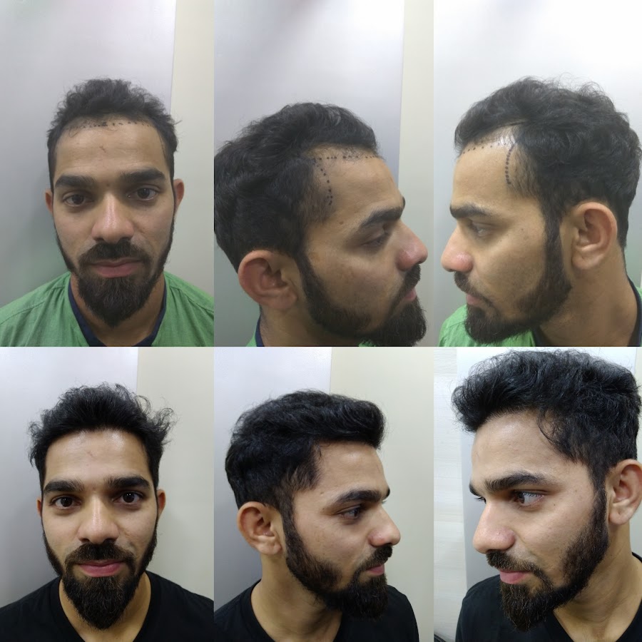 Dr. Mukesh Batra Hair Transplant — photo 2