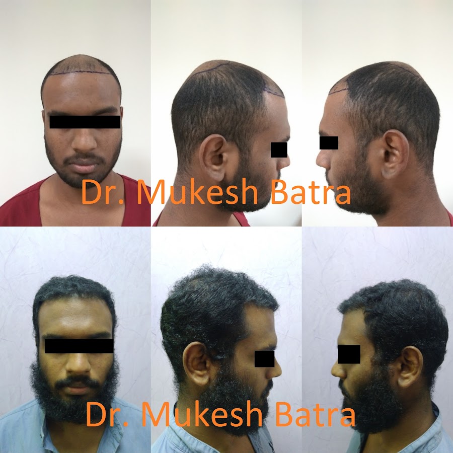 Dr. Mukesh Batra Hair Transplant — photo 4