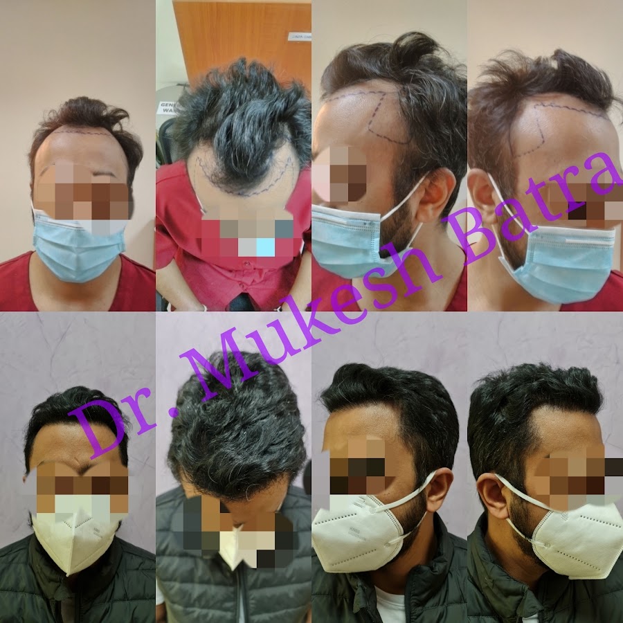 Dr. Mukesh Batra Hair Transplant — photo 5