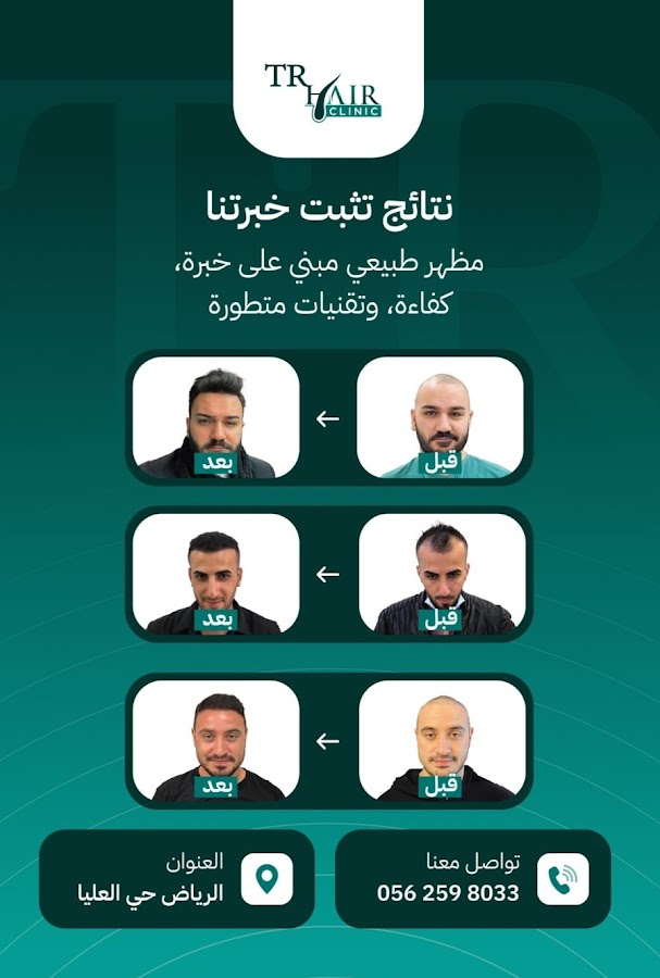 TR Hair Transplant Specialized Clinic | تي ار زراعة الشعر العيادات المتخصصة — photo 4